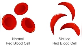 What is sickle cell anaemia, which India plans to eliminate by 2047?