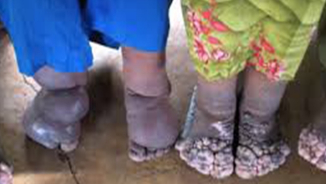 Supportive environment key for eliminating filariasis and leishmaniasis, achieving UHC Supportive environment key for eliminating filariasis and leishmaniasis, achieving UHC