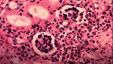 Neglected Tropical Diseases: How community level awareness can help reduce vulnerability