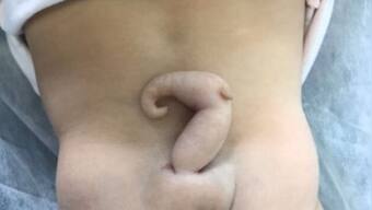 Brazilian baby born with 6-cm-long 'pseudo tail' successfully operated upon; read details