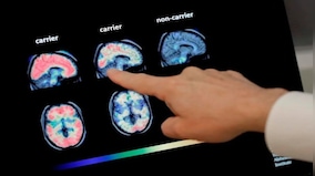 How a 19-year-old teenager was diagnosed with Alzheimer’s disease