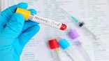 What is the Marburg virus wreaking havoc in Equatorial Guinea? Should we be concerned?