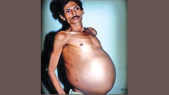 'Fetus in fetu' condition: Nagpur man carrying twin inside not first