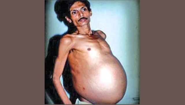 'Fetus in fetu' condition: Nagpur man carrying twin inside not first 'Fetus in fetu' condition: Nagpur man carrying twin inside not first