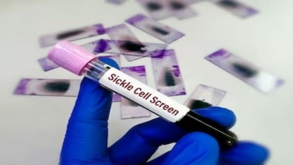 PM Modi launches National Sickle Cell Anaemia Elimination Mission: What is this genetic disorder?