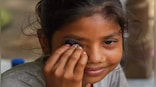 Heavy rain, floods spark conjunctivitis outbreak in Delhi: How bad is it?