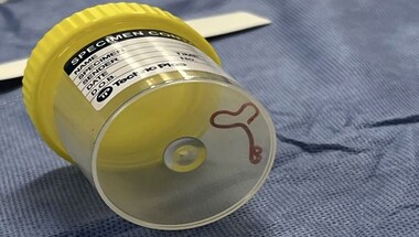 Oh My Worm: How Australian doctors found and removed a 3-inch live parasite from a woman’s brain