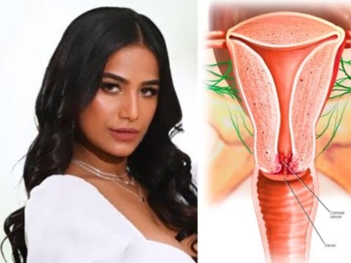 Cervical cancer EXPLAINED: Don’t need Poonam Pandey to raise awareness