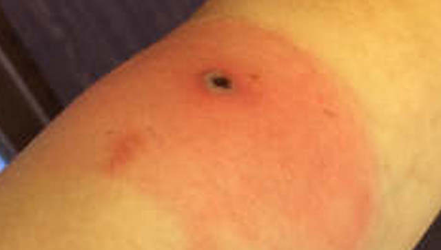 Alaskapox claims its first victim. Should we worry? Alaskapox claims its first victim. Should we worry?