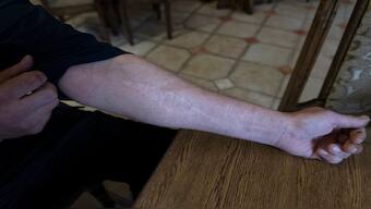 42-year-old Vyacheslav Ryabkov, an internally displaced person from Kozachi Laheri in the Kherson region of Ukraine, shows the scars on his arms caused by Russian soldiers who cut him with a knife. AP