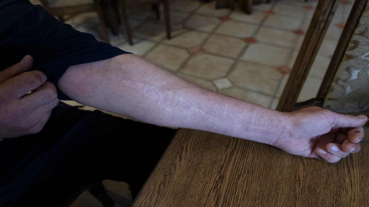 42-year-old Vyacheslav Ryabkov, an internally displaced person from Kozachi Laheri in the Kherson region of Ukraine, shows the scars on his arms caused by Russian soldiers who cut him with a knife. AP 42-year-old Vyacheslav Ryabkov, an internally displaced person from Kozachi Laheri in the Kherson region of Ukraine, shows the scars on his arms caused by Russian soldiers who cut him with a knife. AP