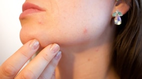 Can your favourite acne cream cause cancer?