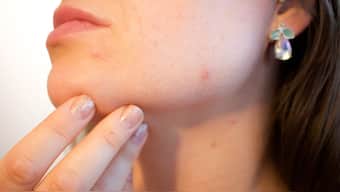 Some popular acne products in the US are found to have benzene. Pixabay (Representational Image)