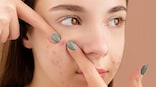 Do you pick your skin? It is more harmful than you think