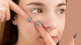 Do you pick your skin? It is more harmful than you think