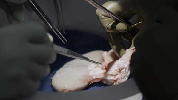  World’s first transplant of genetically-edited pig kidney to a live patient