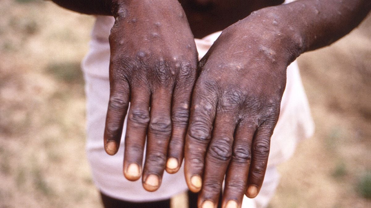 WHO declares mpox a global health emergency, says response plans require $15 million