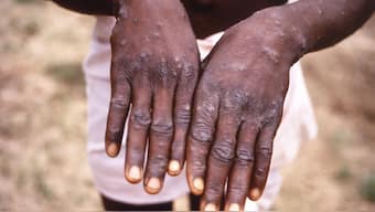 This 1997 image depicts the dorsal surfaces of the hands of a monkeypox case patient. CDC via AP