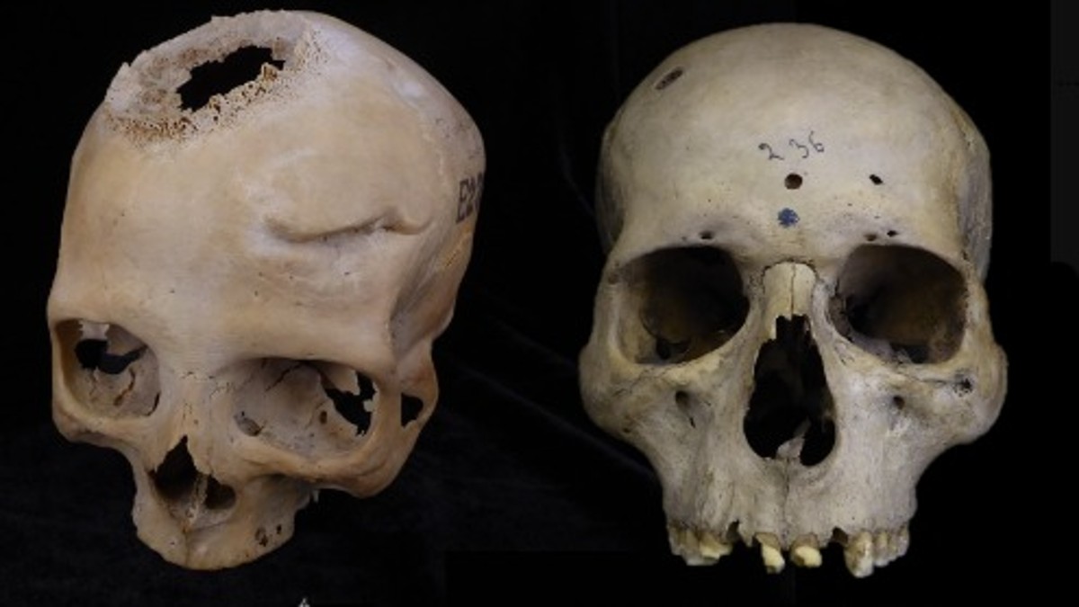 The visible tumours that cancer caused were the main focus of the ancient Egyptians' understanding of the disease. Image Courtesy: @UniversidadeUSC/X The visible tumours that cancer caused were the main focus of the ancient Egyptians' understanding of the disease. Image Courtesy: @UniversidadeUSC/X