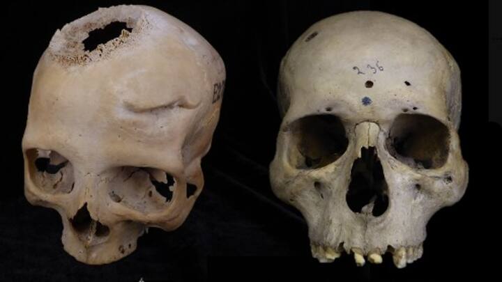 Medical history: How ancient Egyptians tried to treat cancer 4,000 years ago Medical history: How ancient Egyptians tried to treat cancer 4,000 years ago