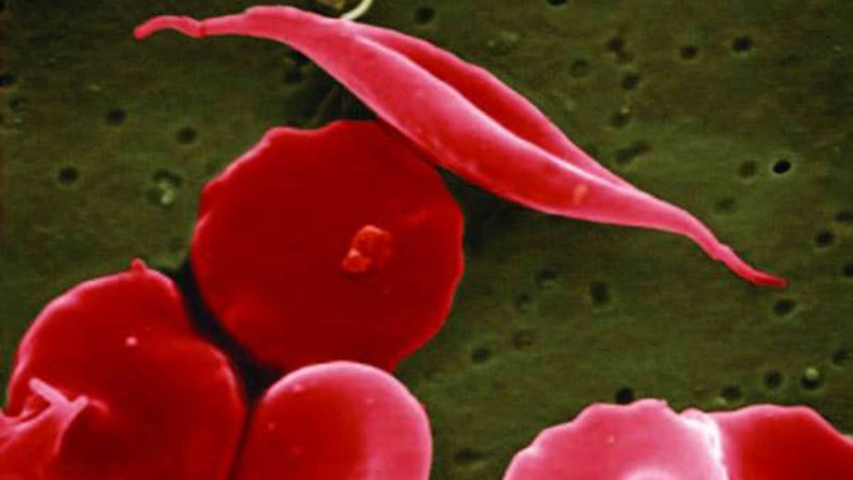 World Sickle Cell Day: Doctor explains how to keep newborns safe