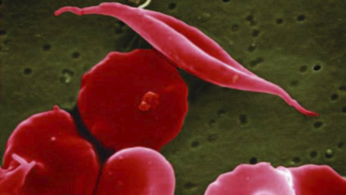 (File) This electron microscope image provided by the National Institutes of Health shows a blood cell altered by sickle cell disease. AP (File) This electron microscope image provided by the National Institutes of Health shows a blood cell altered by sickle cell disease. AP