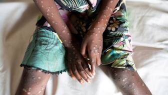 A child with mpox during the 2022 outbreak in the Democratic Republic of the Congo. File Image/Reuters