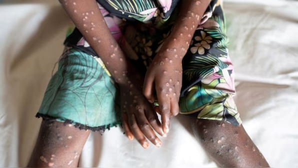 Are young men more likely to contract mpox? WHO data shows...