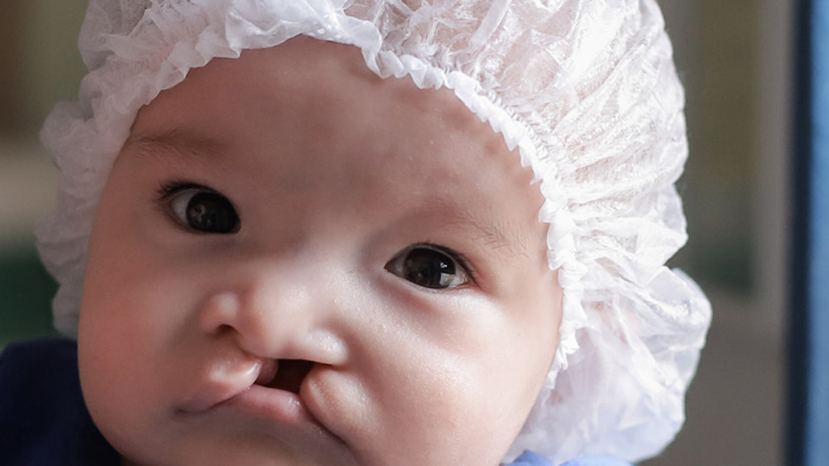 Transforming lives with Smile Train's Global Cleft Care programme Transforming lives with Smile Train's Global Cleft Care programme