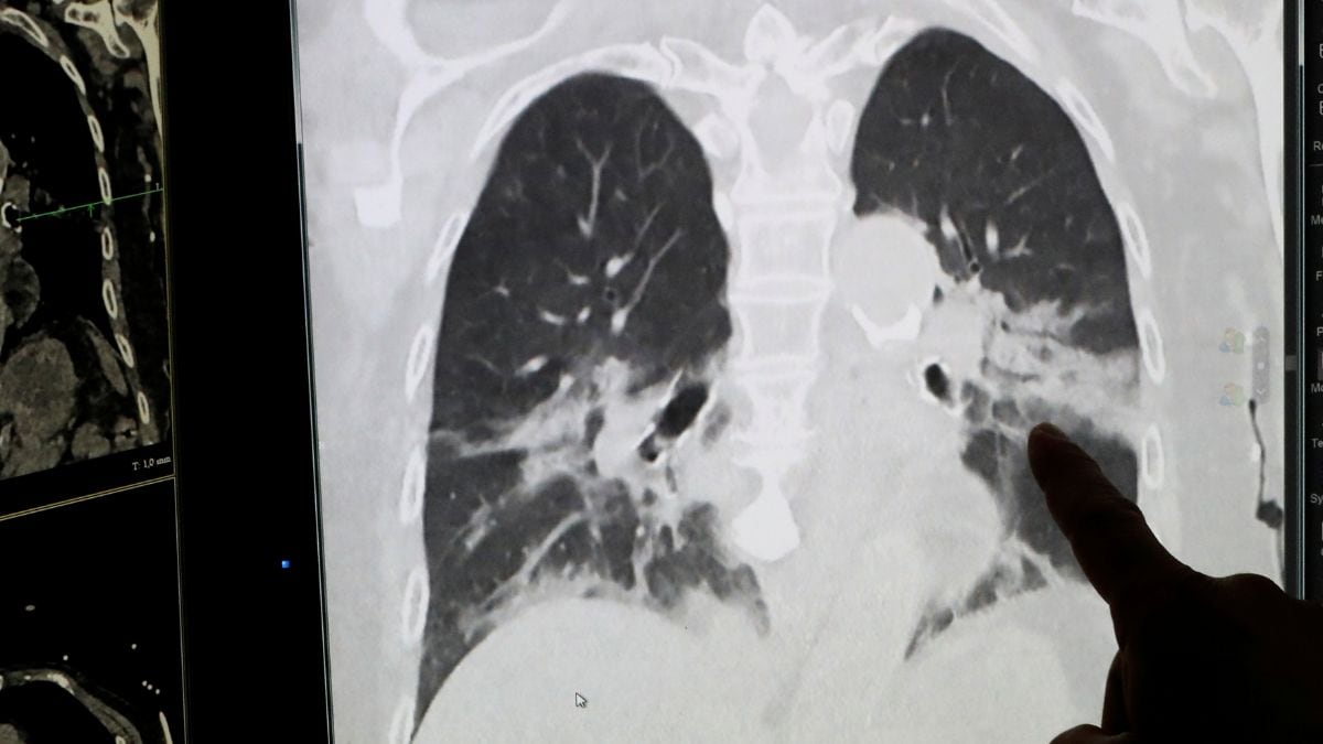 Most of India's lung cancer cases are linked to non-smokers. Here's why