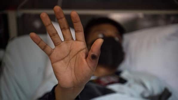 Is India prepared for mpox after it being declared a global health emergency?