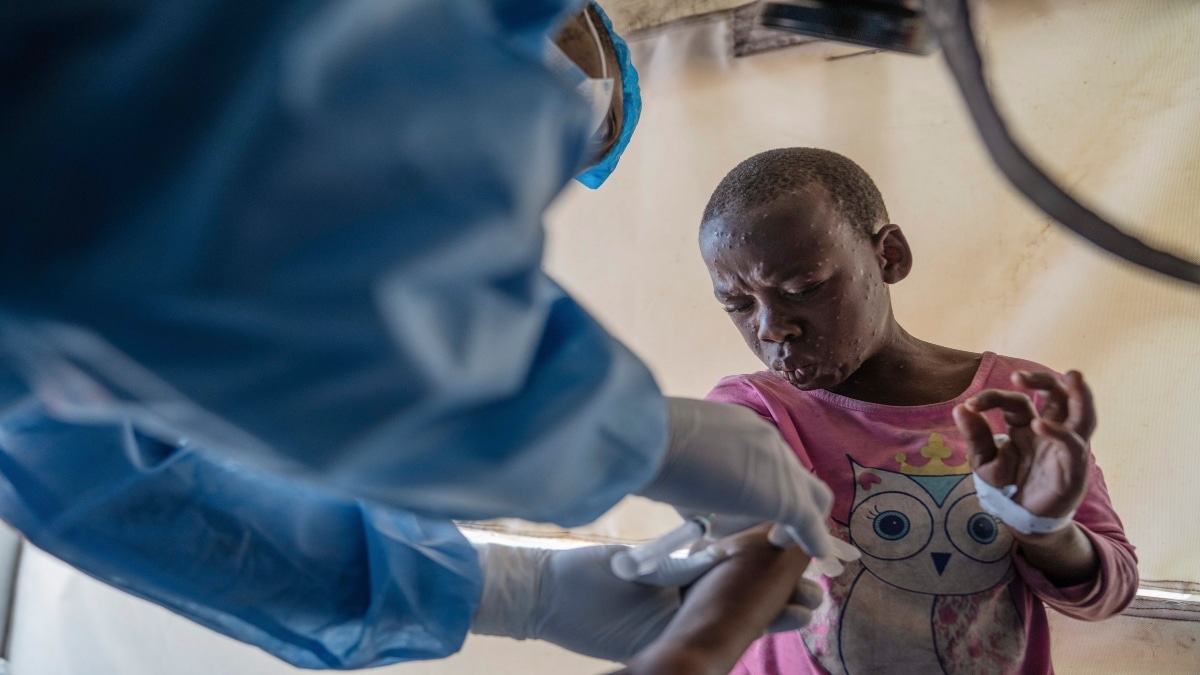 Congo Reports 1,000 New Mpox Cases In A Week, An Underestimate As Only ...