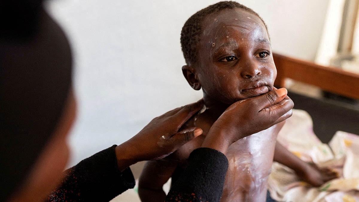 Mpox virus outbreak: New strain mutating faster than expected, resource shortage an issue