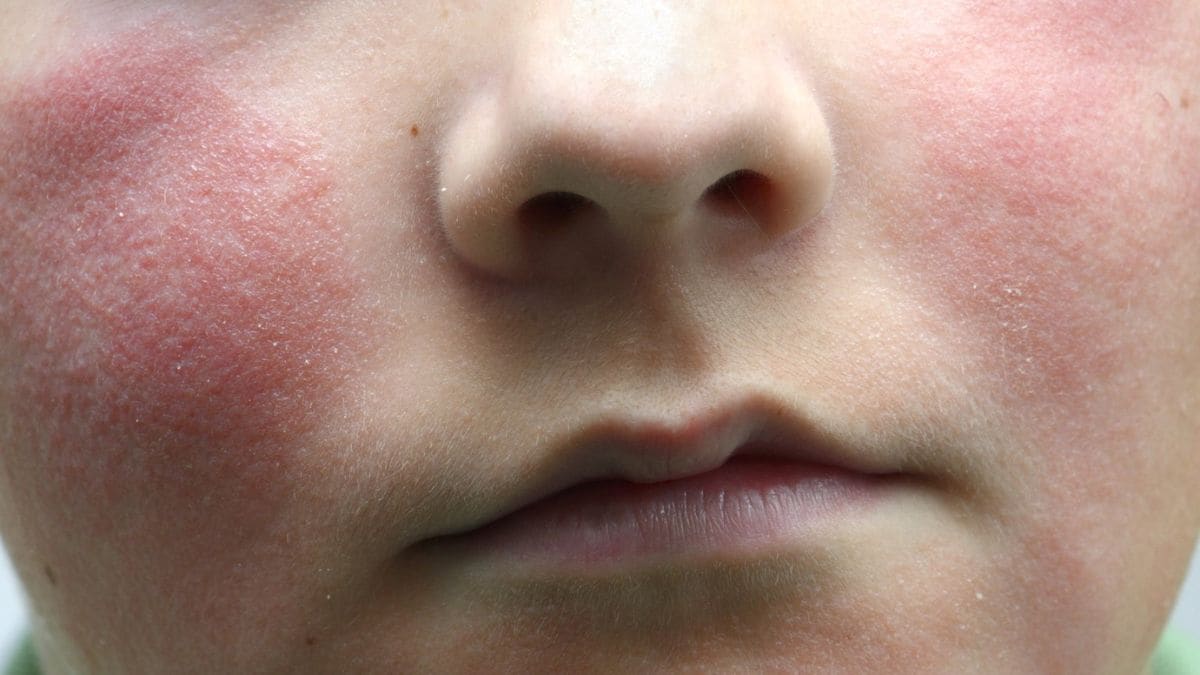 What is ‘slapped cheek virus’, the contagious disease on the rise in the US?