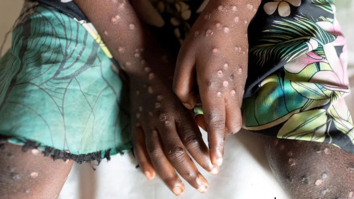 Mpox: Belgium 8th non-African nation to report new variant, WHO says situation ‘especially concerning’ Mpox: Belgium 8th non-African nation to report new variant, WHO says situation ‘especially concerning’