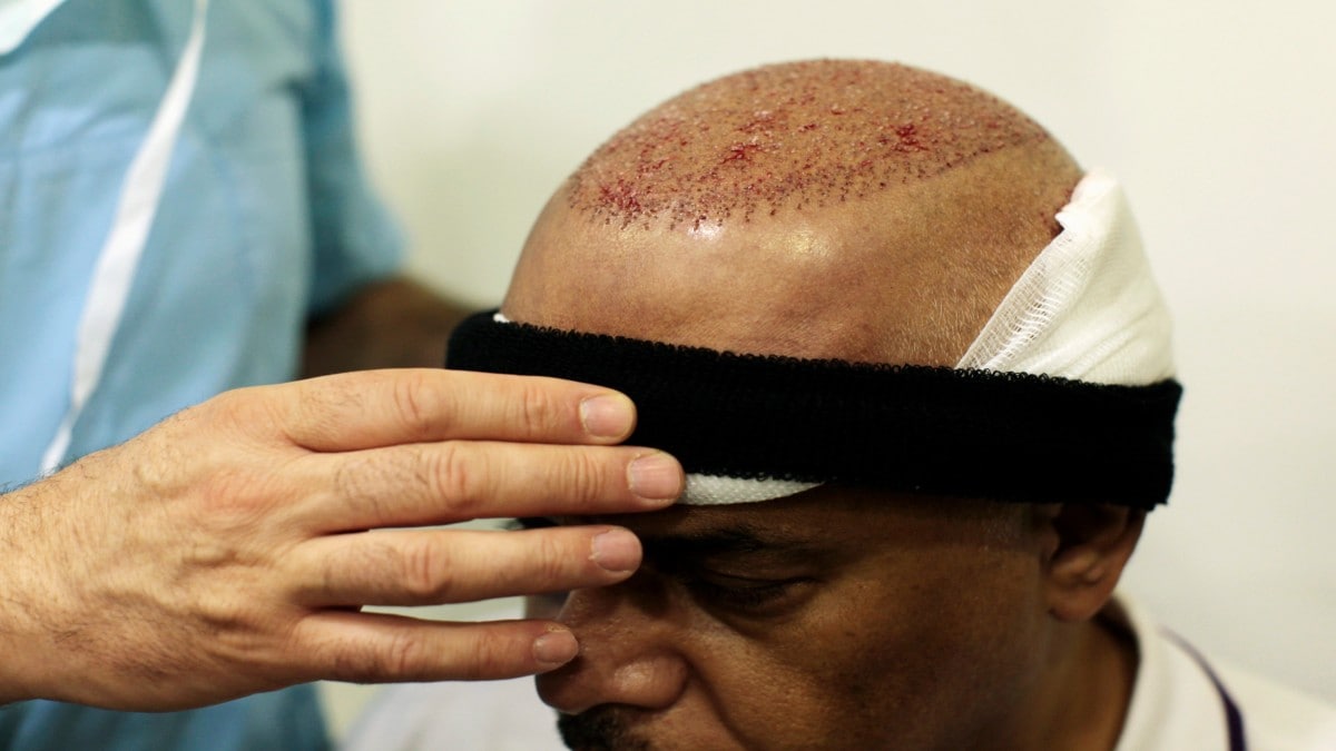 From bald to bold: How safe are hair transplants?