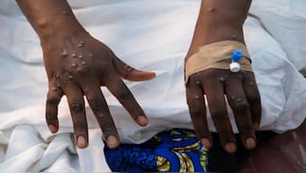 The hands of a patient with skin rashes caused by the mpox virus are pictured at the treatment center of Vijana Hospital in Kinshasa, Democratic Republic of Congo August 30, 2024. Reuters