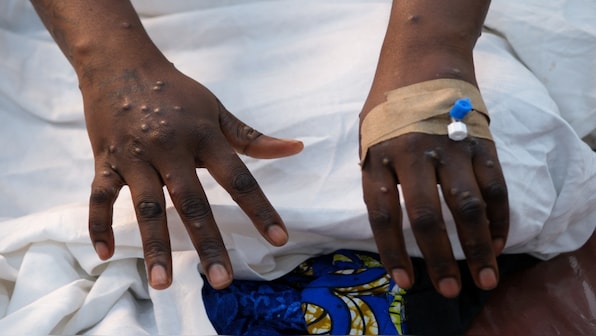 Congo mpox outbreak puts spotlight on sex workers, a big part of mining economy