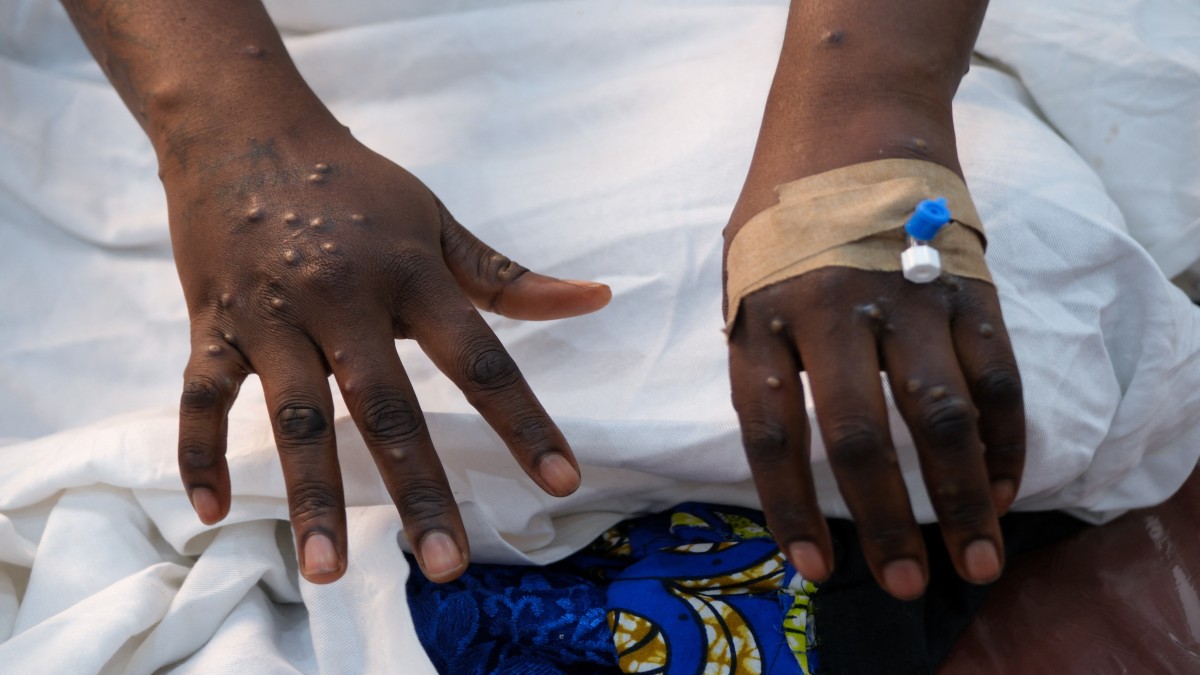 The hands of a patient with skin rashes caused by the mpox virus are pictured at the treatment center of Vijana Hospital in Kinshasa, Democratic Republic of Congo August 30, 2024. Reuters The hands of a patient with skin rashes caused by the mpox virus are pictured at the treatment center of Vijana Hospital in Kinshasa, Democratic Republic of Congo August 30, 2024. Reuters