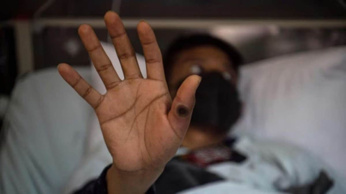 26-year-old Haryana man is India first confirmed mpox case, should Indians be worried? – Firstpost