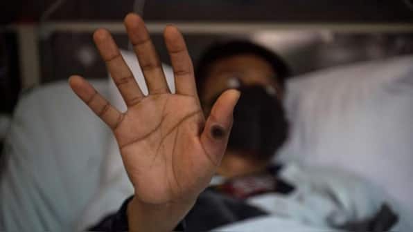 Mpox in India: 26-year-old Haryana man first confirmed case, should Indians be worried?