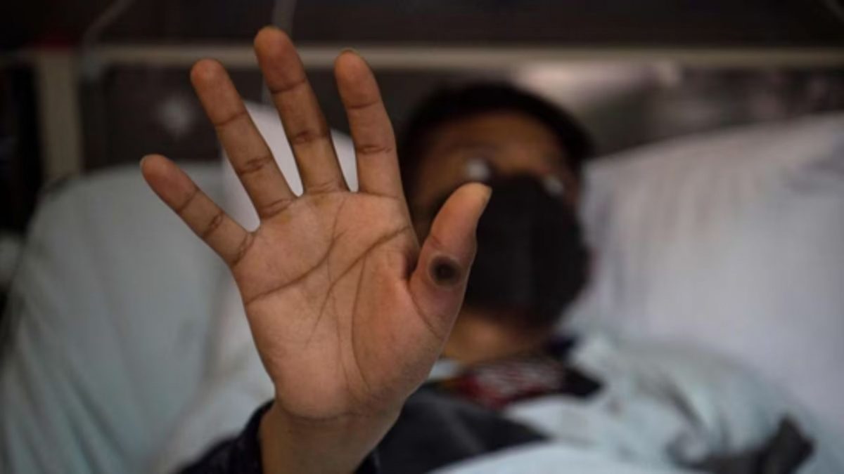Mpox in India: 26-year-old Haryana man first confirmed case, should Indians be worried? Mpox in India: 26-year-old Haryana man first confirmed case, should Indians be worried?
