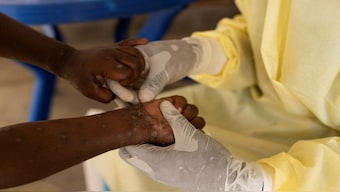 A man in Kerala has reported India's first mpox clade 1b infection. Experts note that this strain is more virulent. Representational image/Reuters