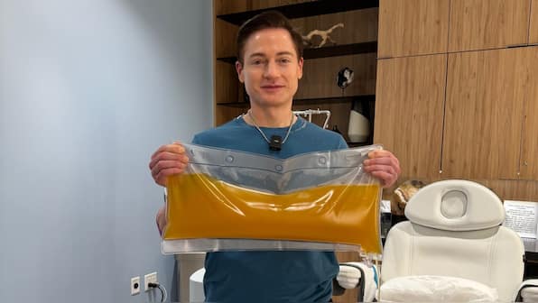 What is total plasma exchange, the procedure that US billionaire underwent to remove toxins?