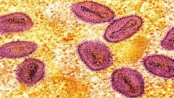An undated colorized transmission electron micrograph of mpox virus particles (pink) found within an infected cell (yellow), cultured in the laboratory, captured at the National Institute of Allergy and Infectious Diseases (NIAID) Integrated Research Facility (IRF) in Fort Detrick, Maryland. Reuters File