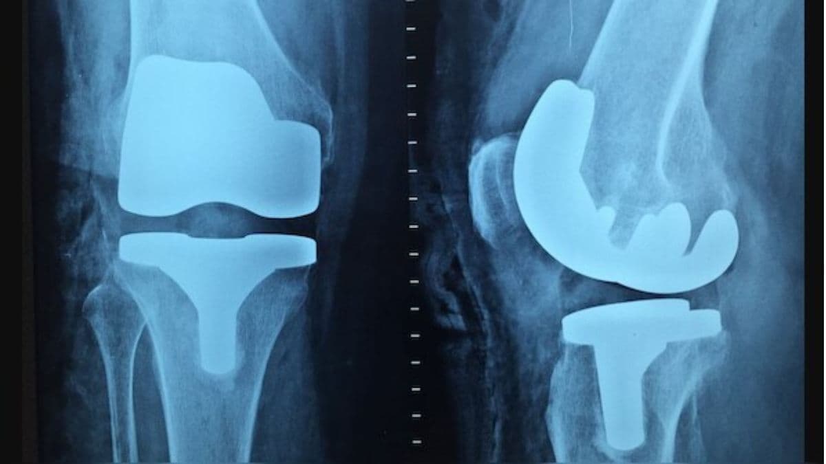 Women Face Double the Risk of Osteoporosis Compared to Men