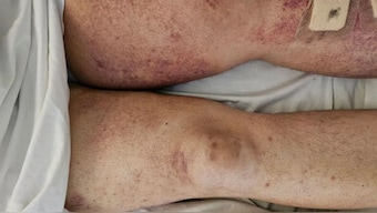 Scurvy is caused by a vitamin C deficiency. Image courtesy: BMJ Case Reports