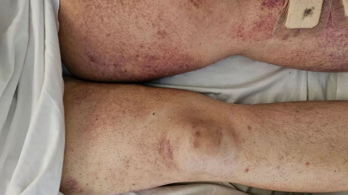 What's the 15th-century disease 'scurvy' making a comeback? What's the 15th-century disease 'scurvy' making a comeback?