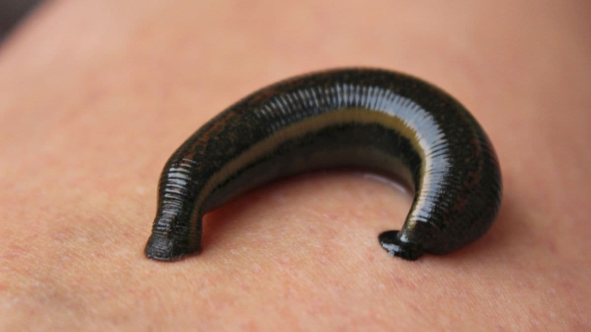 How leeches for treatment are making a comeback