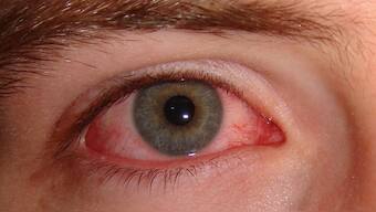 This virus causes viral hemorrhagic fever, attacking blood vessels and potentially leading to heavy internal bleeding. In the most extreme cases, it results in blood seeping from the eyes, which gives the virus its eerie name. Image for Representation. Image courtest: Wikimedia Commons
